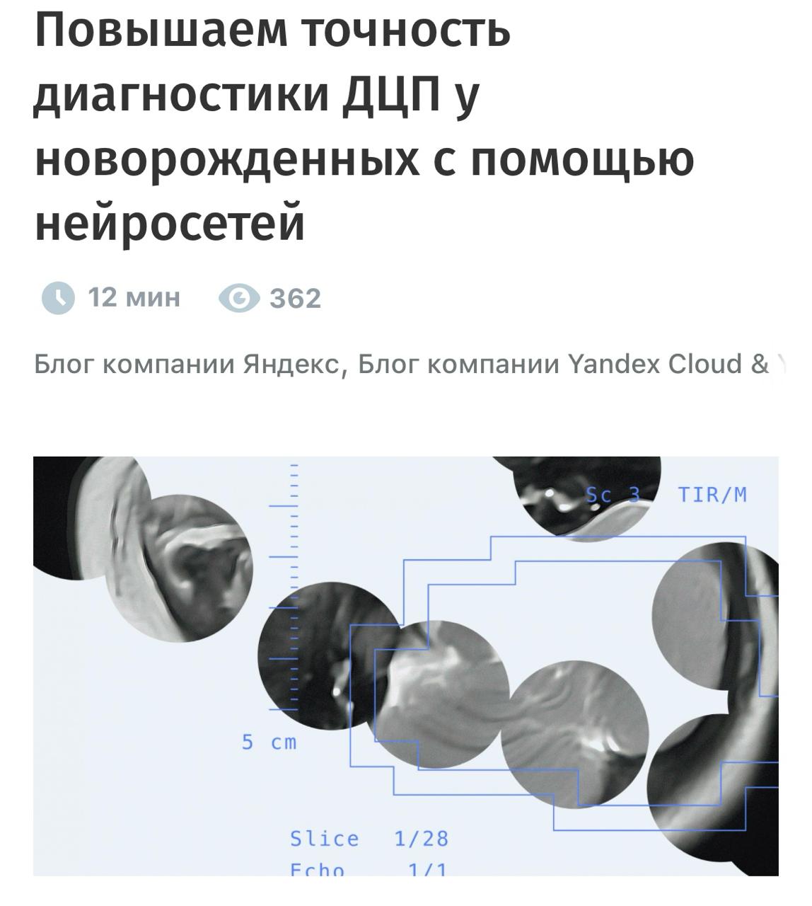 5218 Yandex Pristato Dirbtinį Intelektą Greitam Cerebrinio Paraly