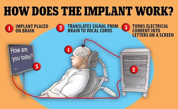 Stenforde Sukurtas Implantas Geba Skaityti Mintis