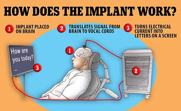 Stenforde Sukurtas Implantas Geba Skaityti Mintis