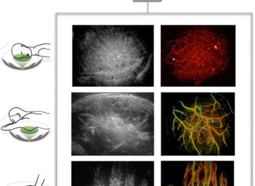 1678 Nauja Ultragarsinė Technologija Leidžia Matyti Kraujagysles 