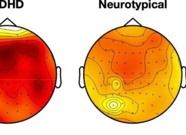1798 Tyrimas Smegenų Veikla Su Sddh Gali Paaiškinti Dėmesio Sutr