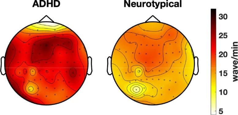 Tyrimas: Smegenų veikla su SDDH gali paaiškinti dėmesio sutrikimus
