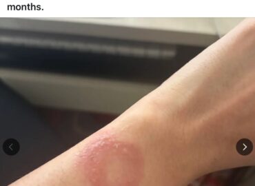 6792 Apple Watch Vartotojas Susidūrė Su Perkaitimo Problema Ir Nu