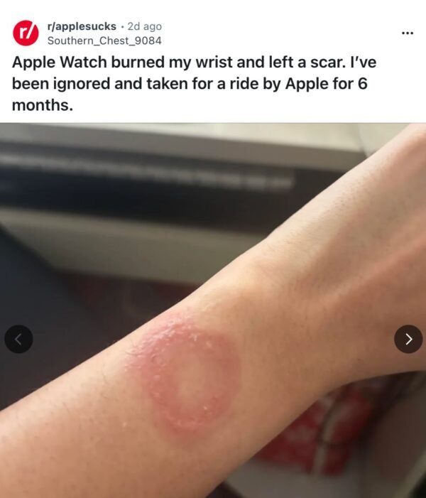 Apple Watch vartotojas susidūrė su perkaitimo problema ir nudegimu