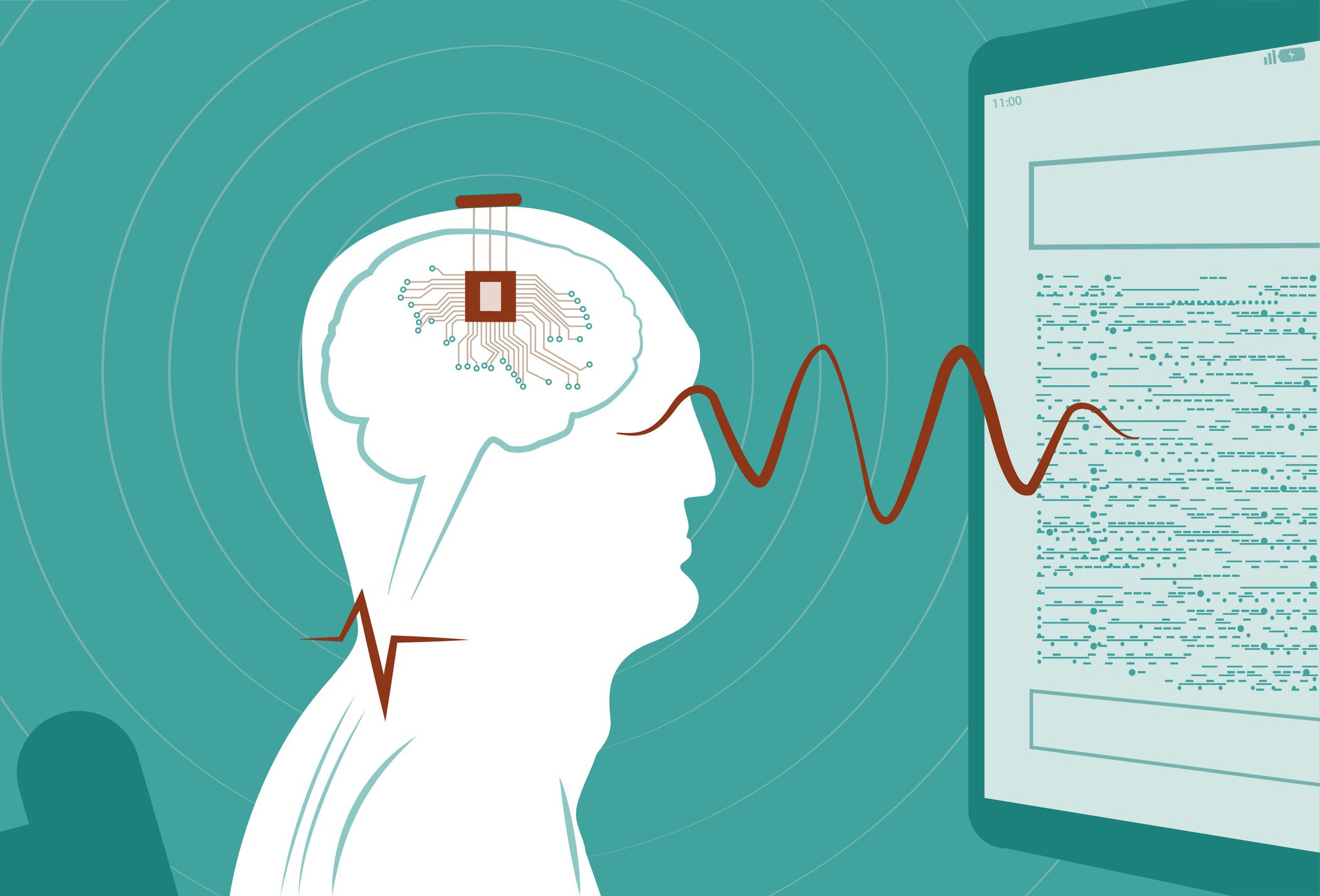 Kinija Patvirtino Pirmuosius Smegen Implantus Pardavimui Ir Siekia Dominuoti Rinkoje