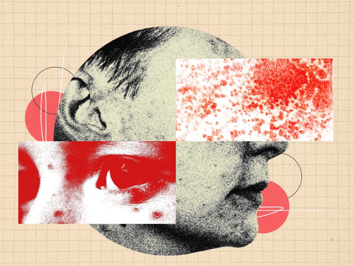 Juostin Pslelin Pavojai Ir Emos Skiepijimo Apimtys