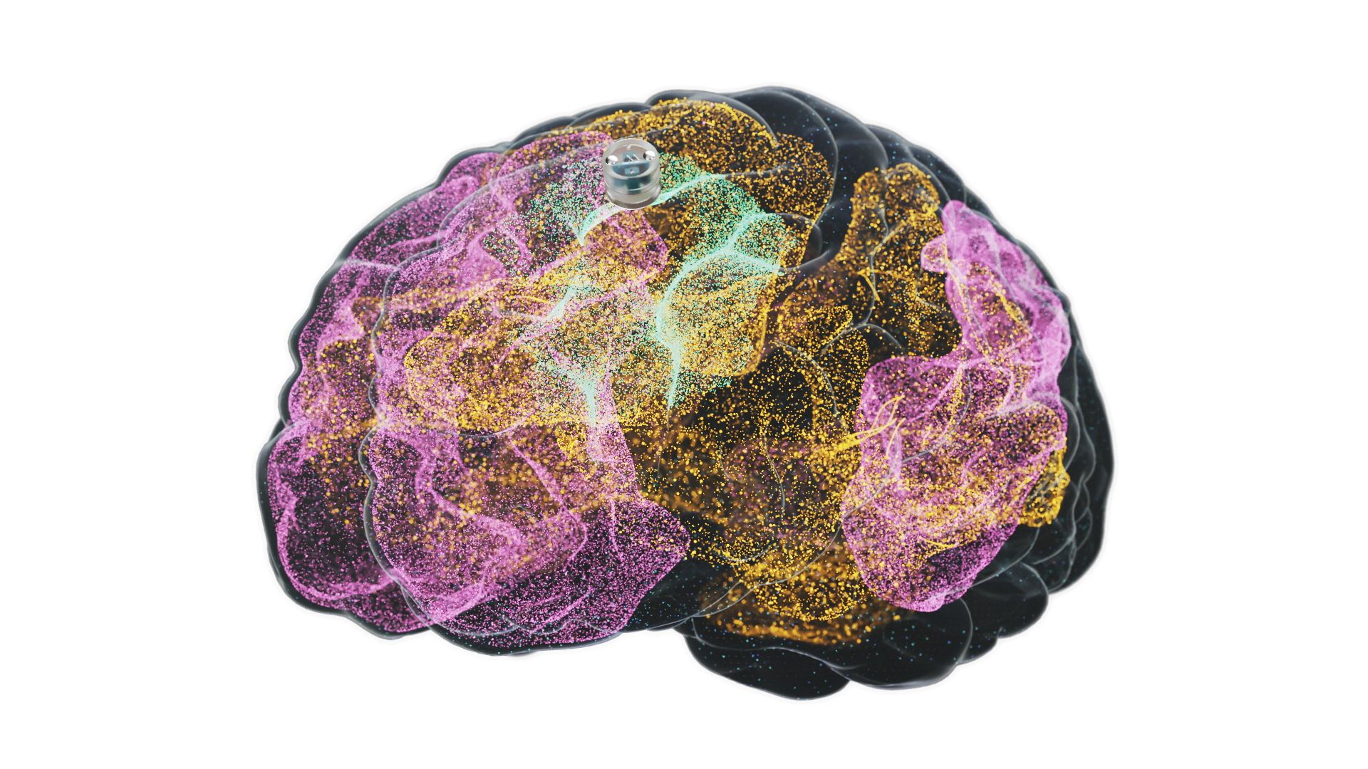 Smegen Implantas Depresijai Gydyti Artja Moni Bandymai