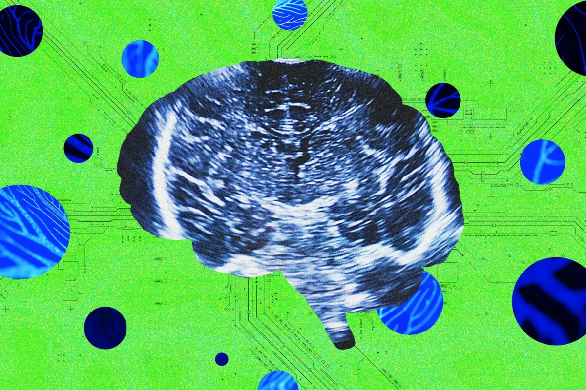 Bridge Neurotech pristatė planus kurti ultragarsu veikiantį nešiojamą smegenų ir kompiuterio sąsajos įrenginį